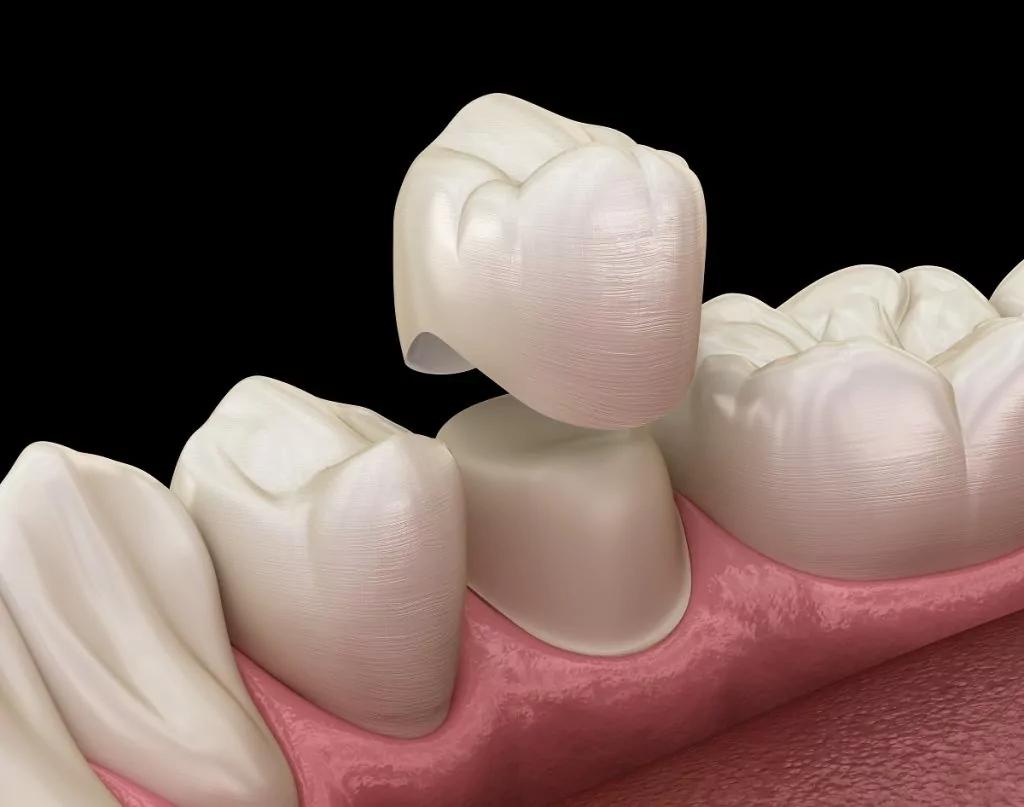 The Incredible Benefits of a Dental Crown