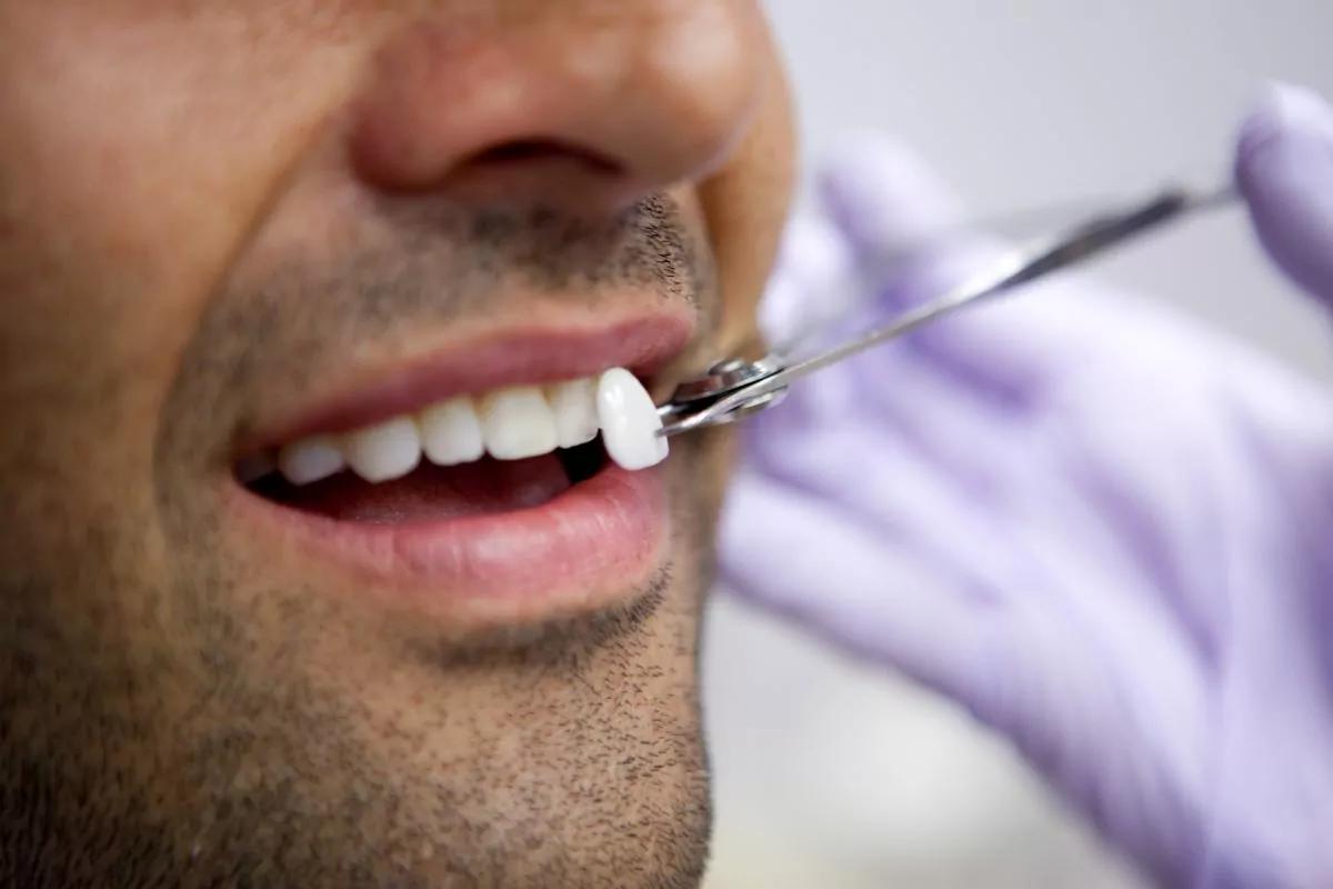 4 Frequent Misconceptions About Porcelain Veneers