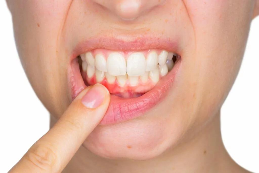 Understanding the Stages of Gum Disease