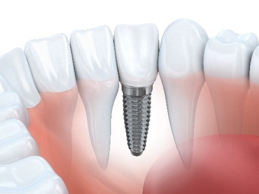 Dental Implants at Porter Dental Health Clinic
