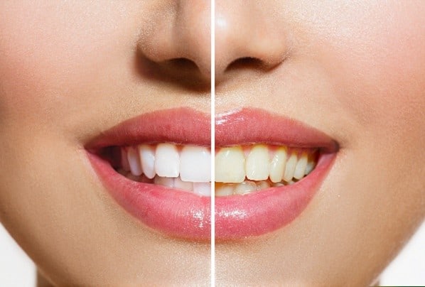 Teeth Whitening at Porter Dental Health Clinic