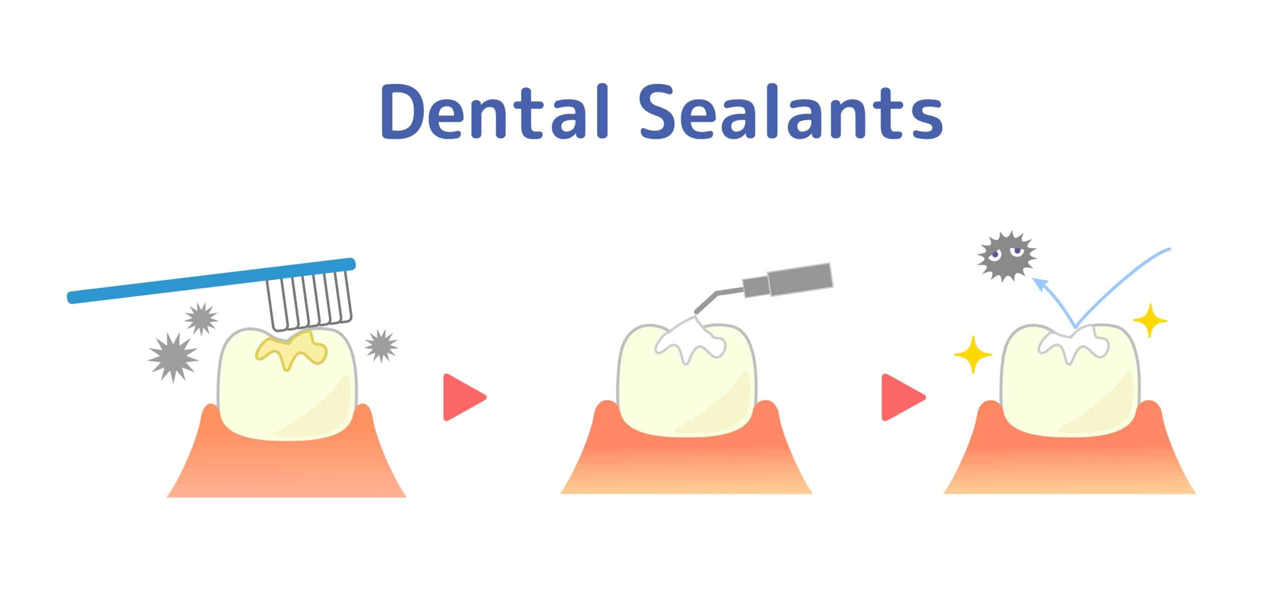 Should You Get Dental Sealants?