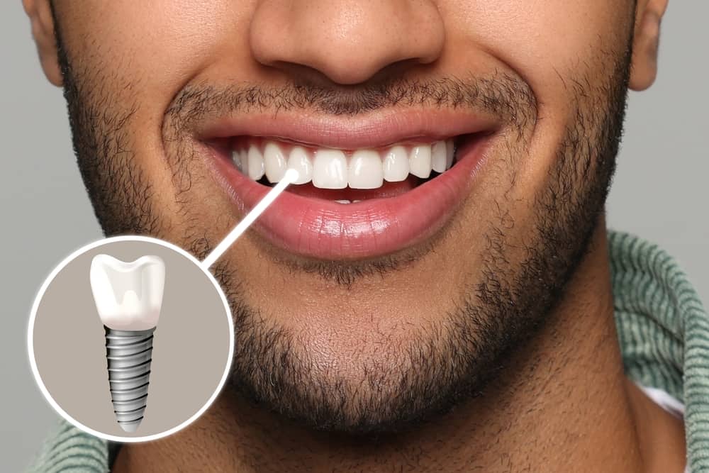 How to Take Care of Your Dental Implant