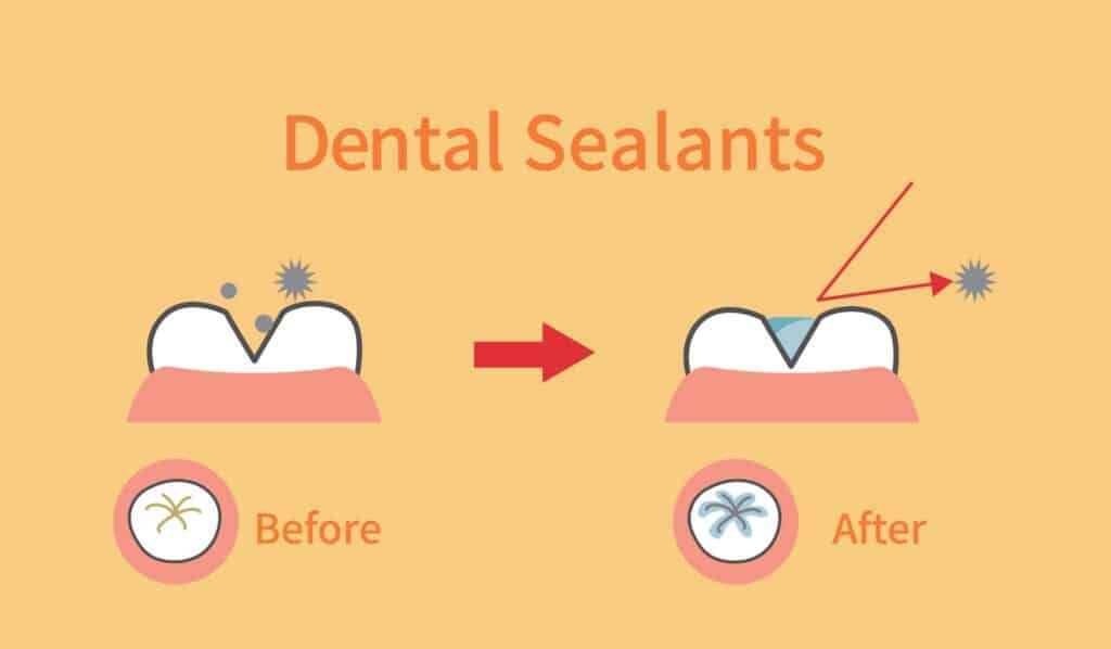 Dental sealants in Hot Springs, AR
