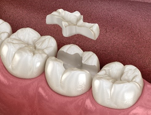 DENTAL CROWNS DENTAL CROWNS