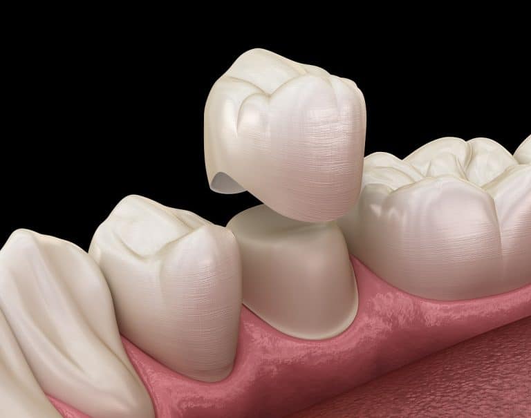 PORCELAIN VENEERS PORCELAIN VENEERS