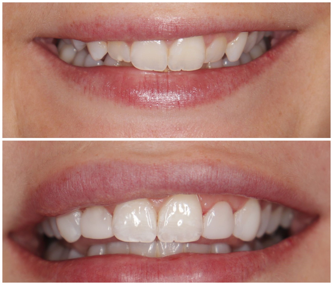 Before and After Image: Composite Fillings - front
