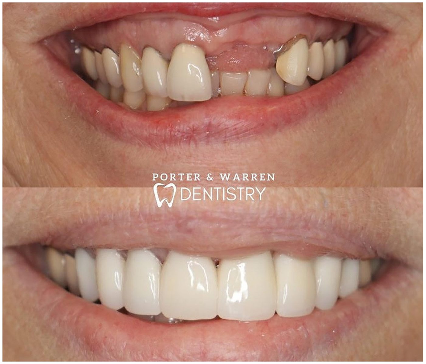 Before and After Image: Anterior Implants - front