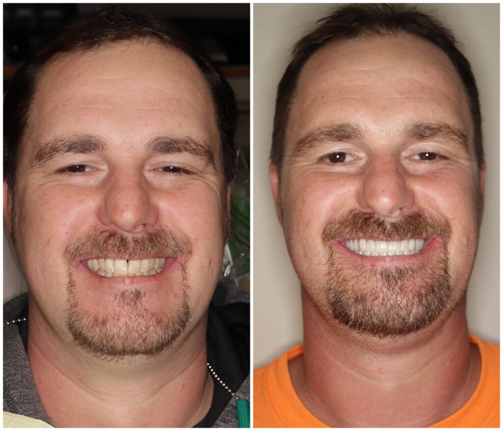 Before and After Image: All-On-Four Implants - front