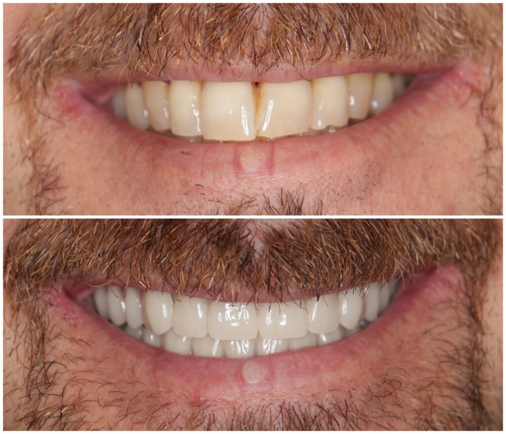 Before and After Image: All-On-Four Implants - front