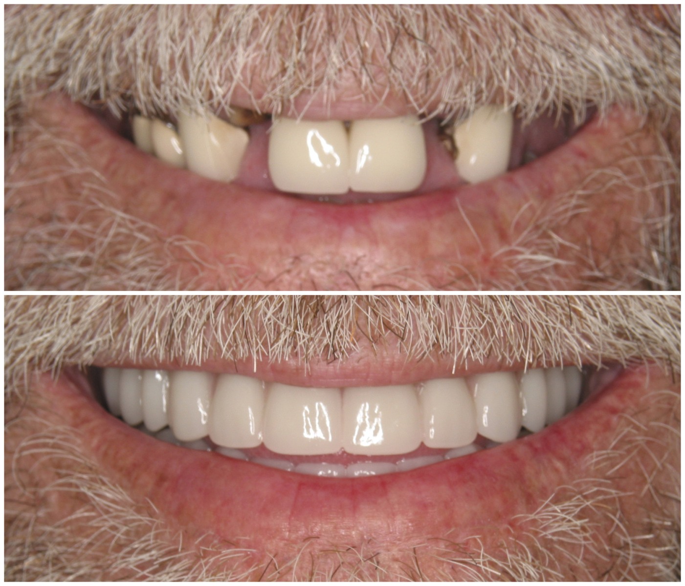 Before and After Image: All-On-Four Implants - front