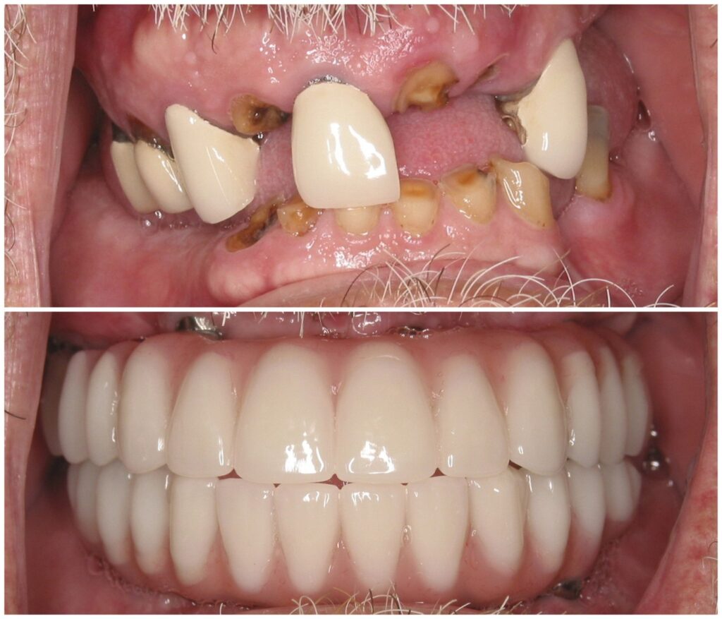 Before and After Image: All-On-Four Implants - front