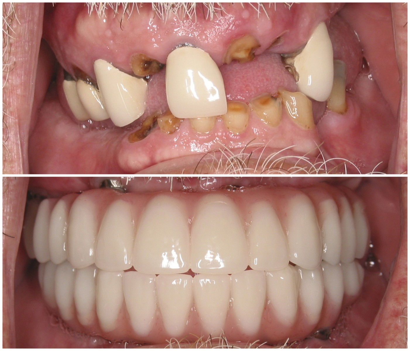 Before and After Image: All-On-Four Implants - front