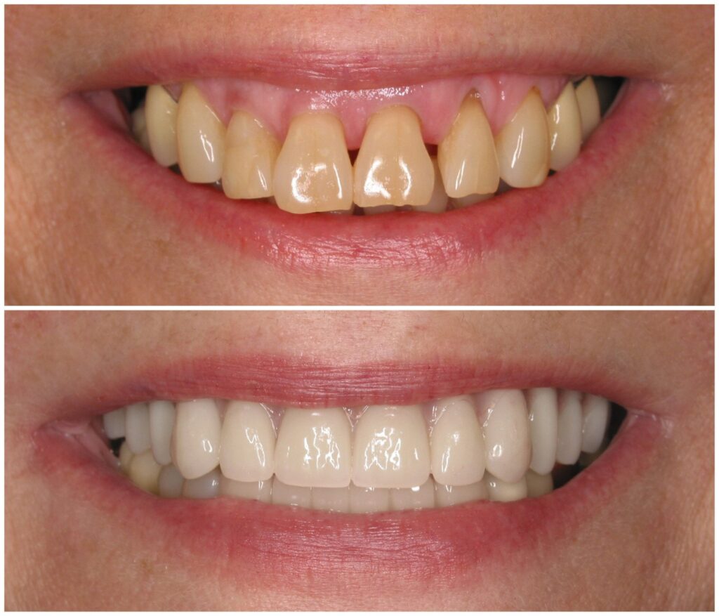 Before and After Image: All-On-Four Implants - front