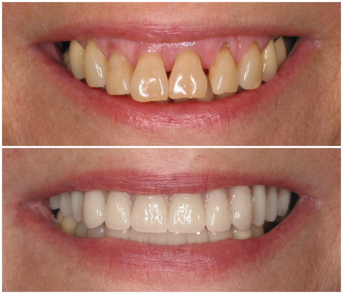 Before and After Image: All-On-Four Implants - front