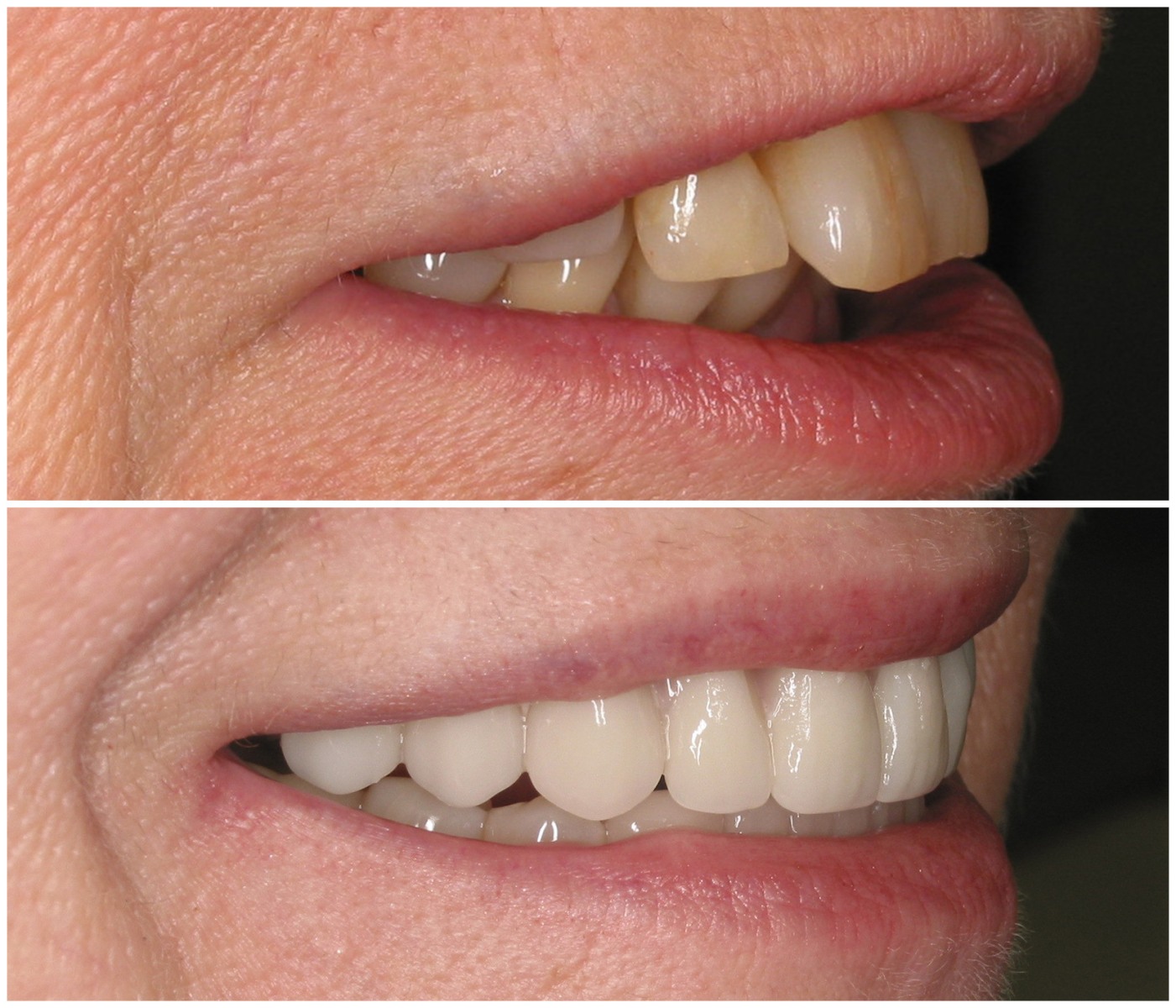 Before and After Image: All-On-Four Implants - right-front-oblique