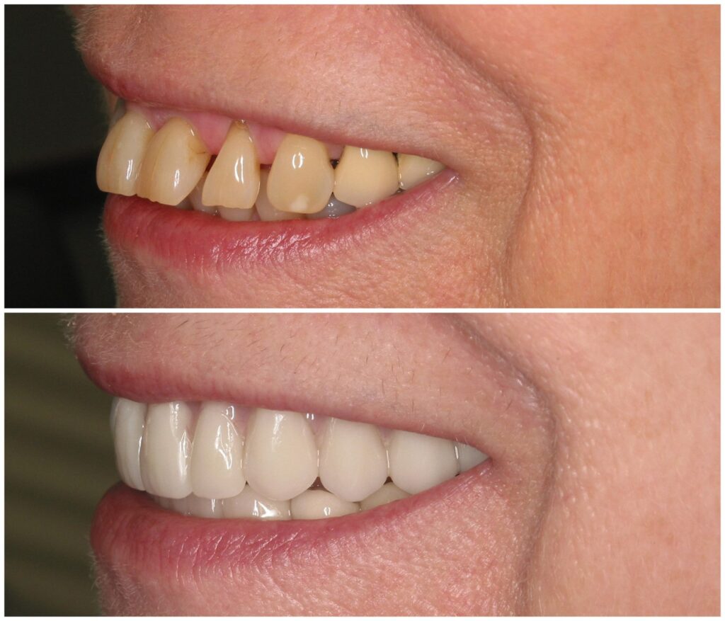 Before and After Image: All-On-Four Implants - left-front-oblique