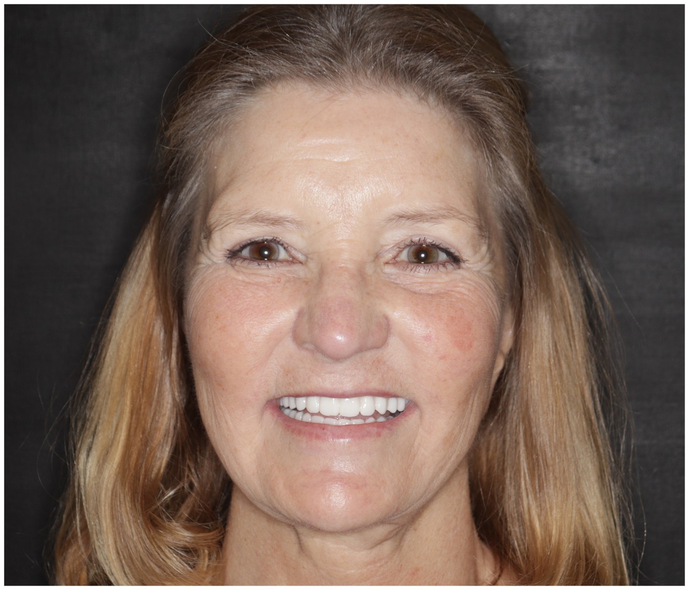 Before and After Image: All-On-Four Implants - front