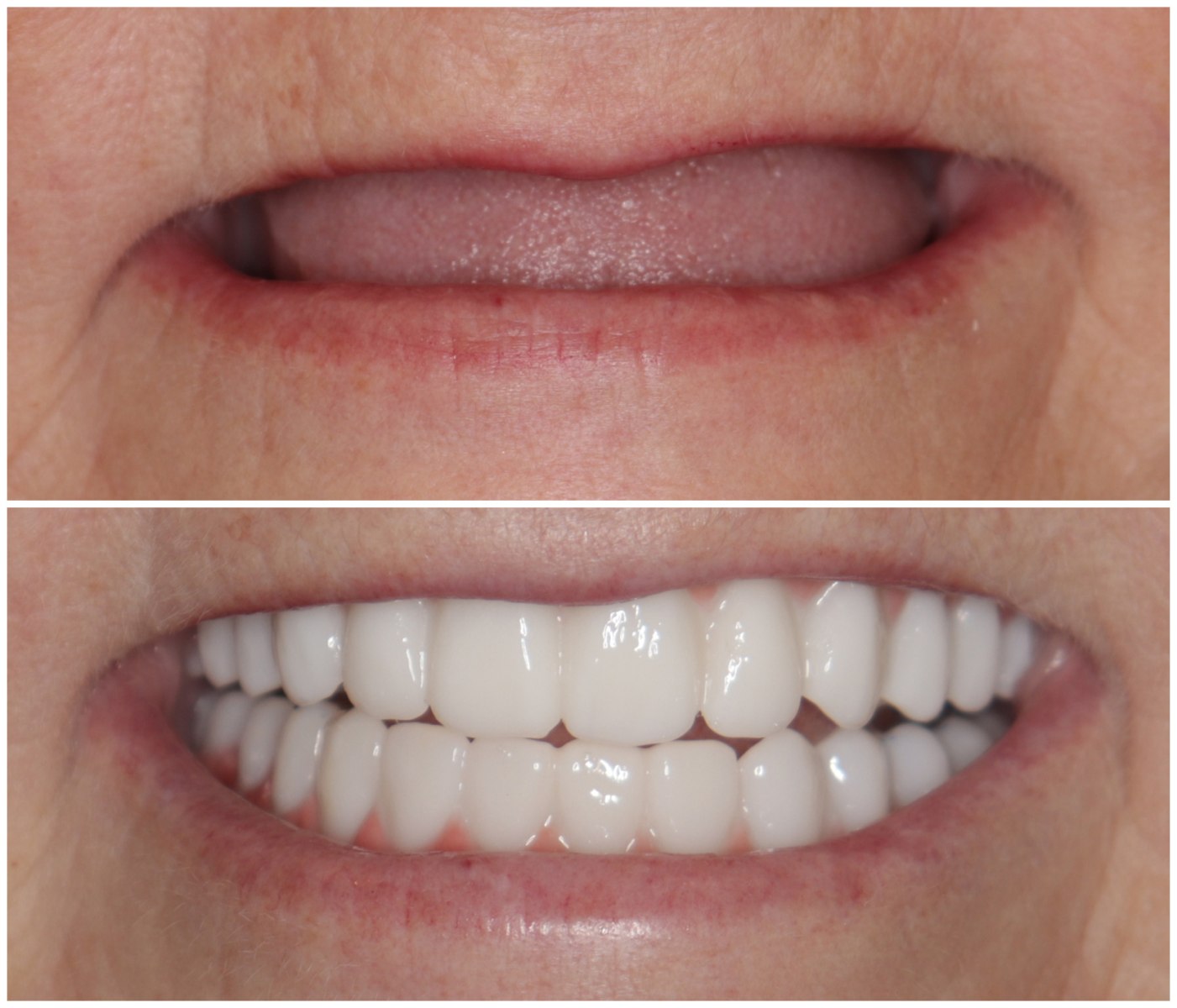 Before and After Image: All-On-Four Implants - front