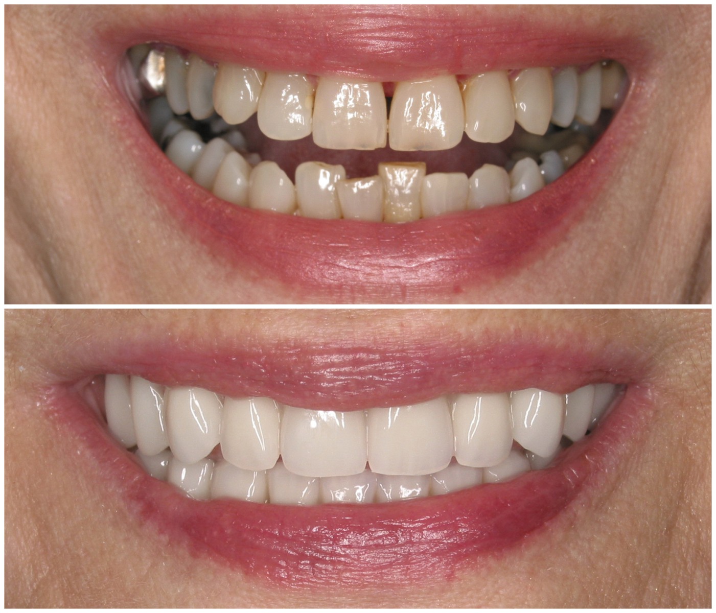 Before and After Image: All-On-Four Implants - front