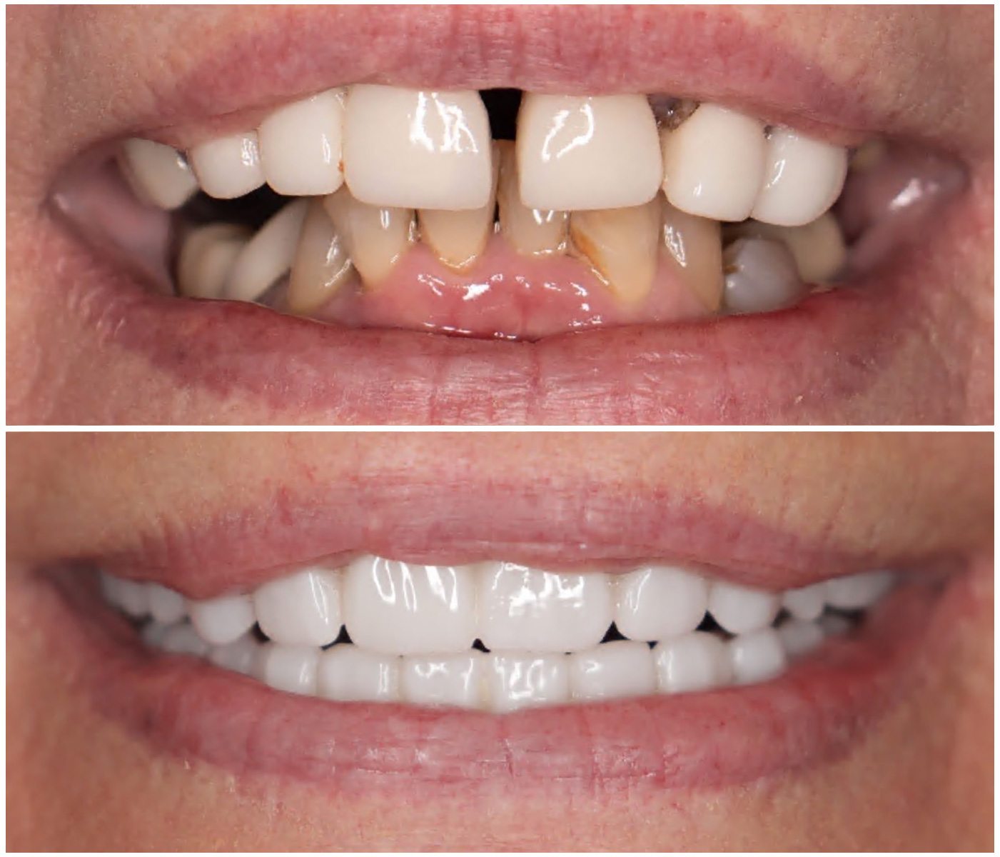 Before and After Image: All-On-Four Implants - front