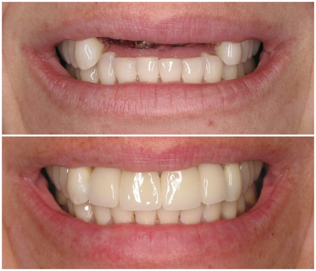Before and After Image: Anterior Implants - front