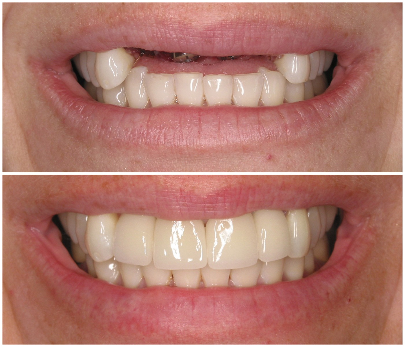 Before and After Image: Anterior Implants - front
