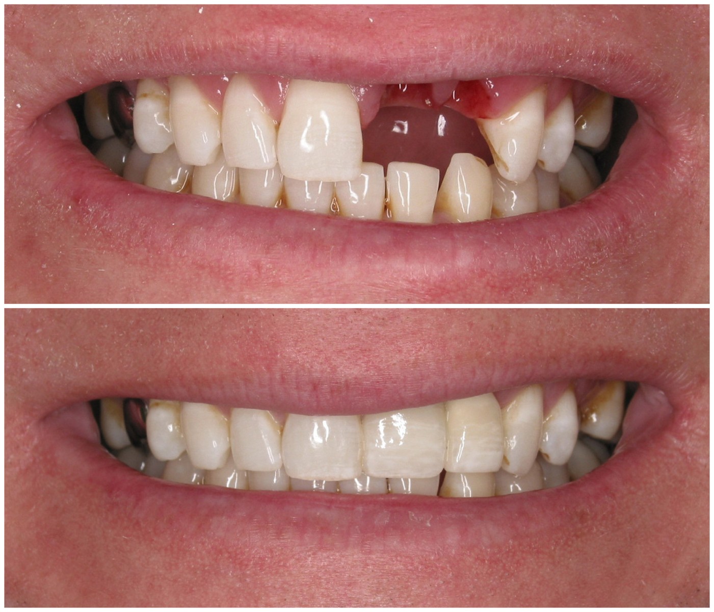 Before and After Image: Anterior Implants - front