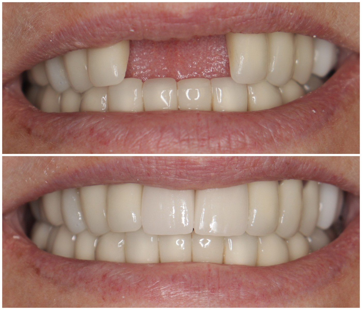 Before and After Image: Anterior Implants - front