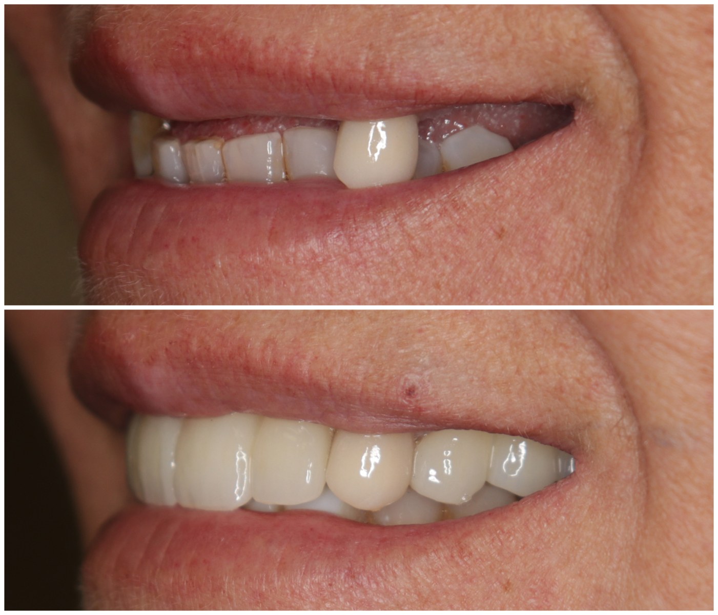 Before and After Image: Anterior Implants - left-front-oblique
