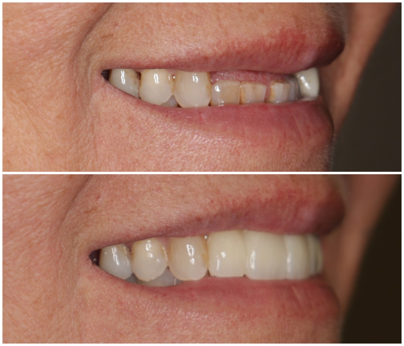 Before and After Image: Anterior Implants - right-front-oblique