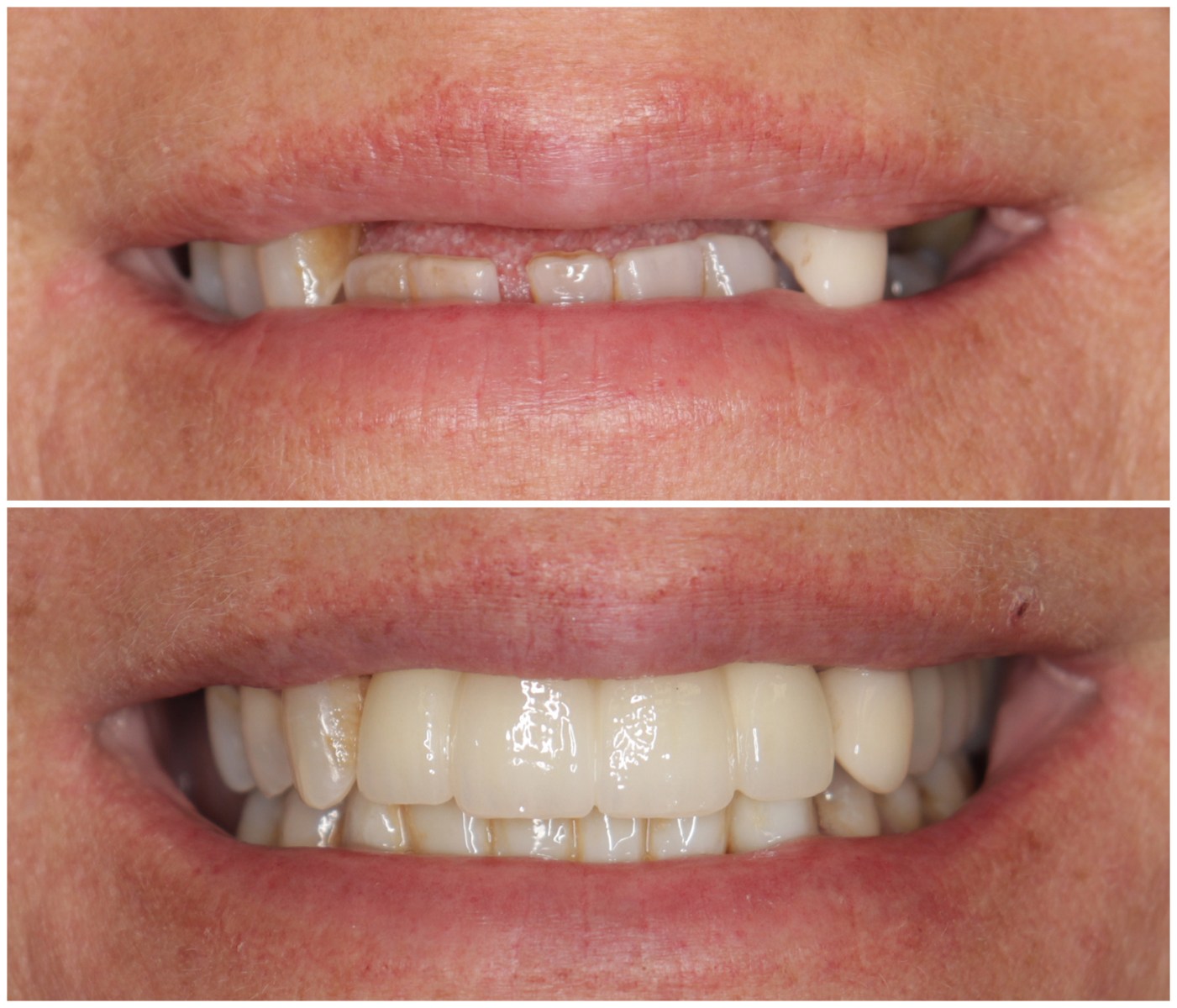 Before and After Image: Anterior Implants - front