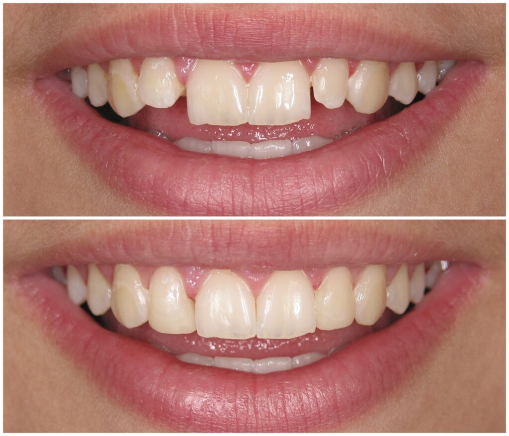 Before and After Image: Composite Fillings - front
