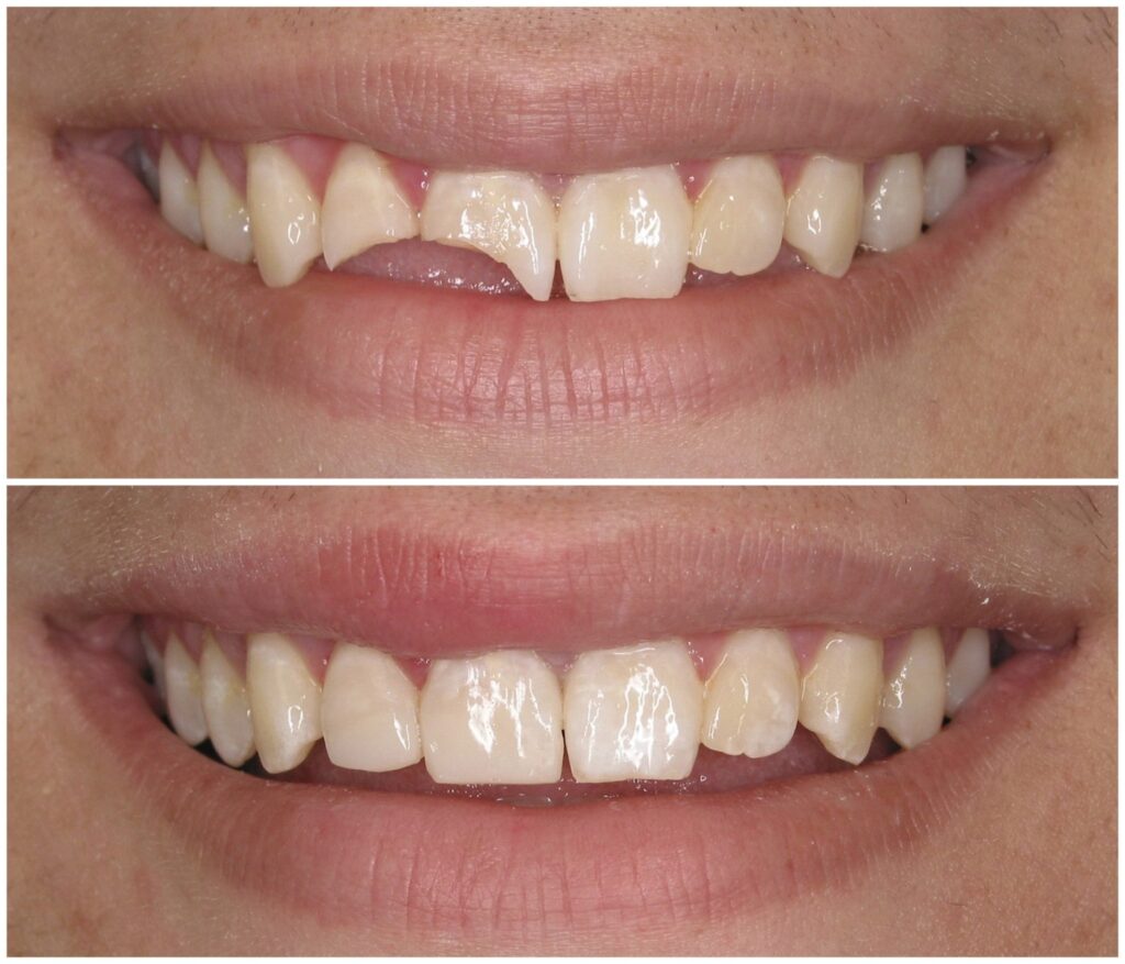 Before and After Image: Composite Fillings - front
