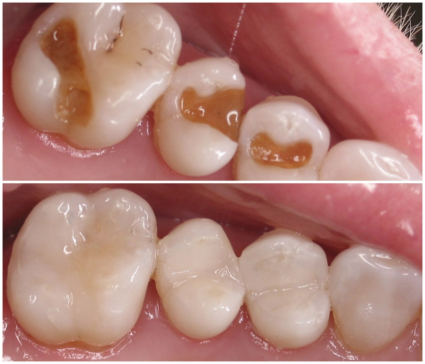 Before and After Image: Composite Fillings - front