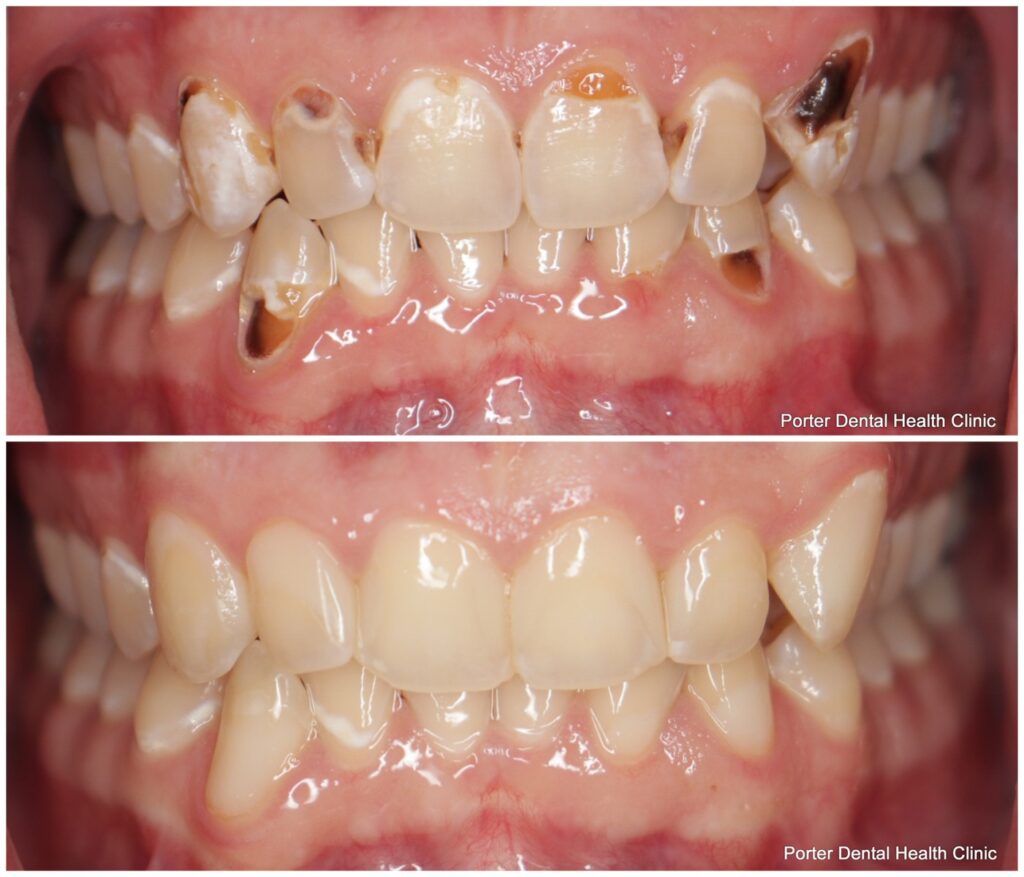 Before and After Image: Composite Fillings - front