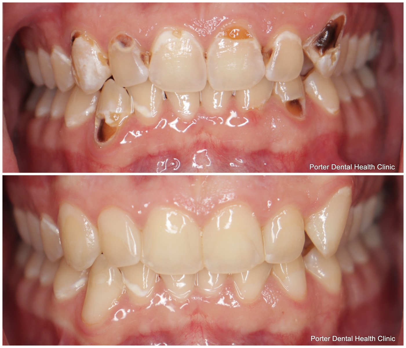 Before and After Image: Composite Fillings - front