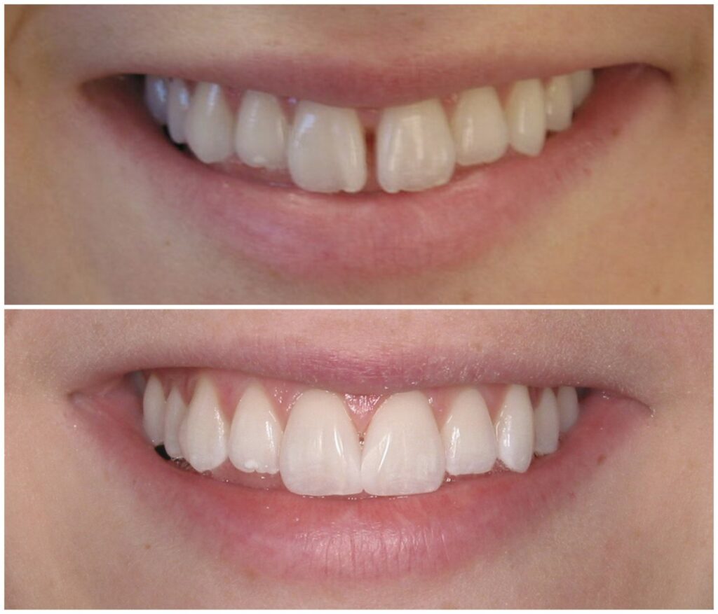 Before and After Image: Composite Fillings - front