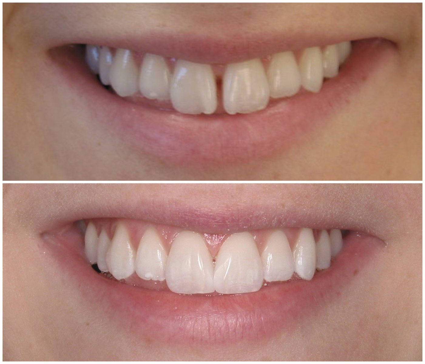 Before and After Image: Composite Fillings - front