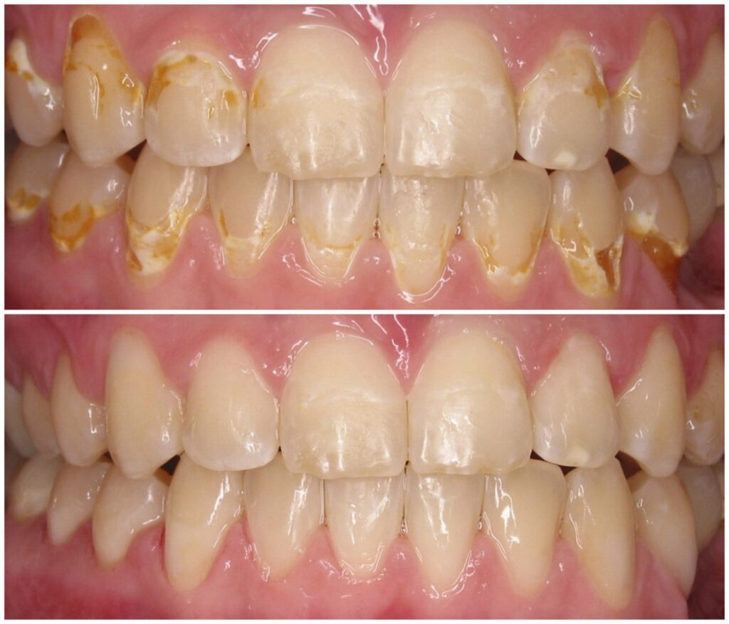 Before and After Image: Composite Fillings - front