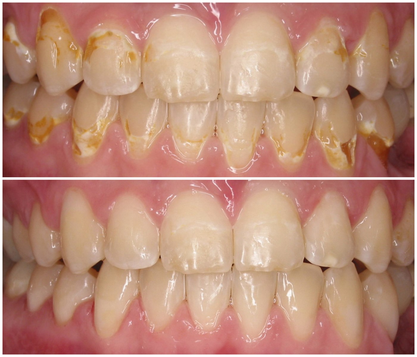 Before and After Image: Composite Fillings - front