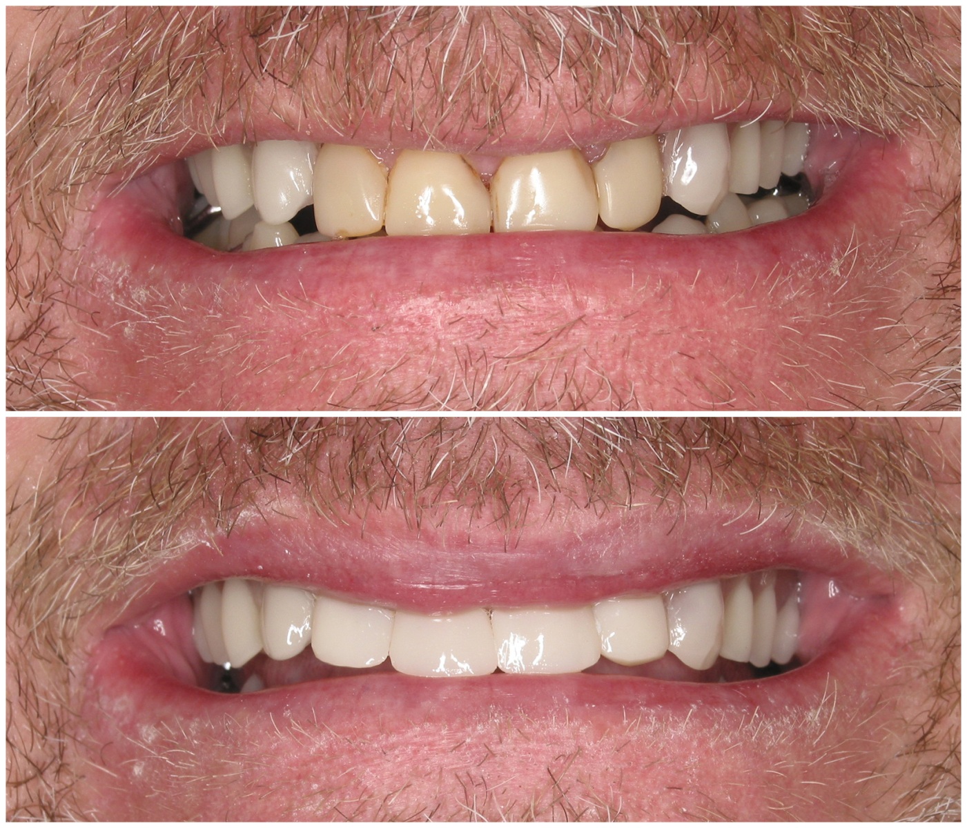 Before and After Image: Composite Fillings - front