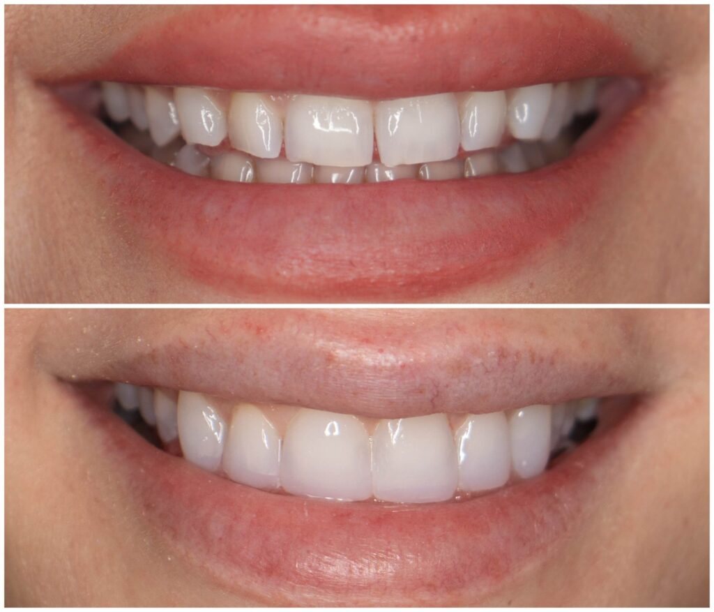 Before and After Image: Composite Fillings - front