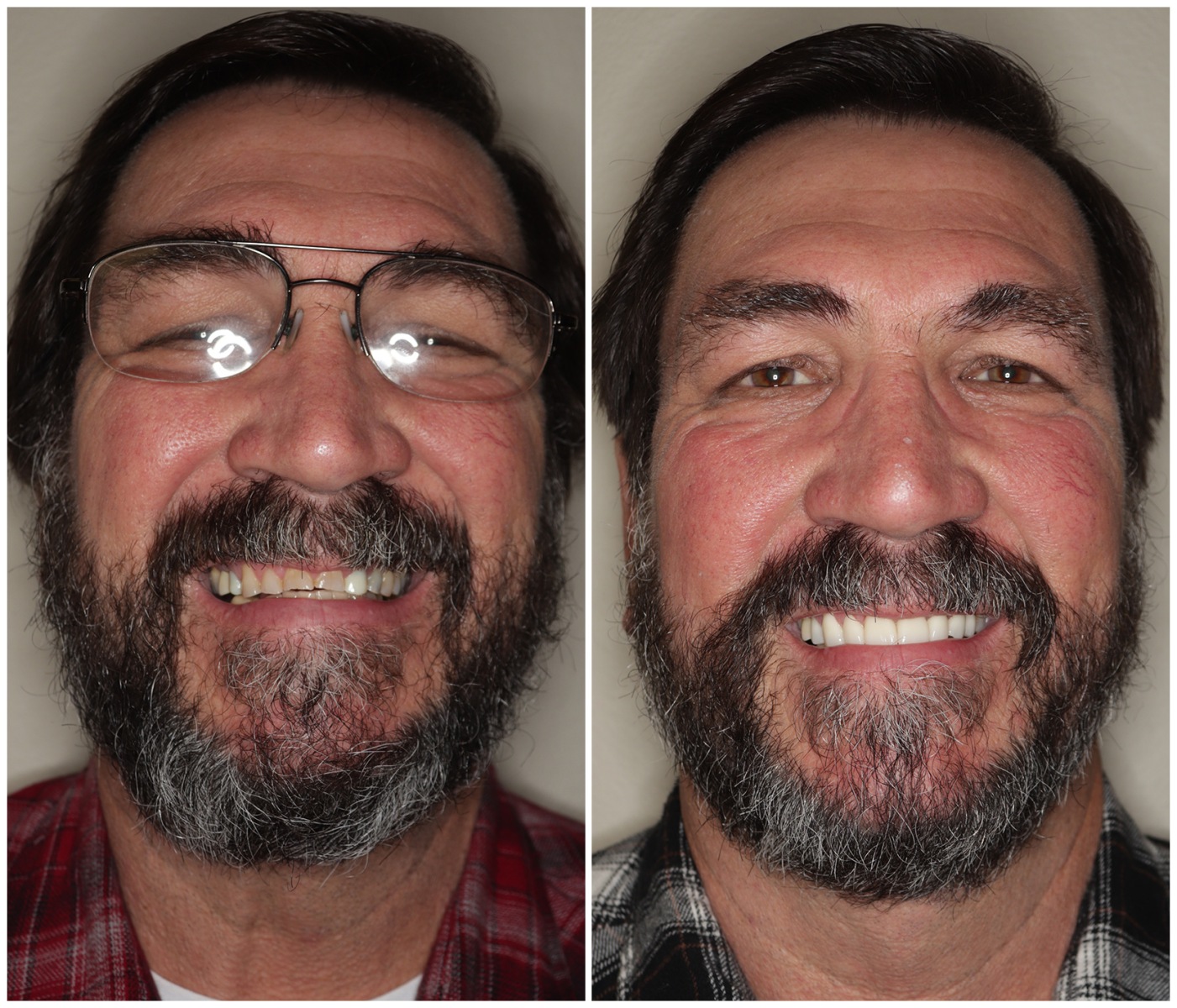 Before and After Image: Porcelain Crowns - front