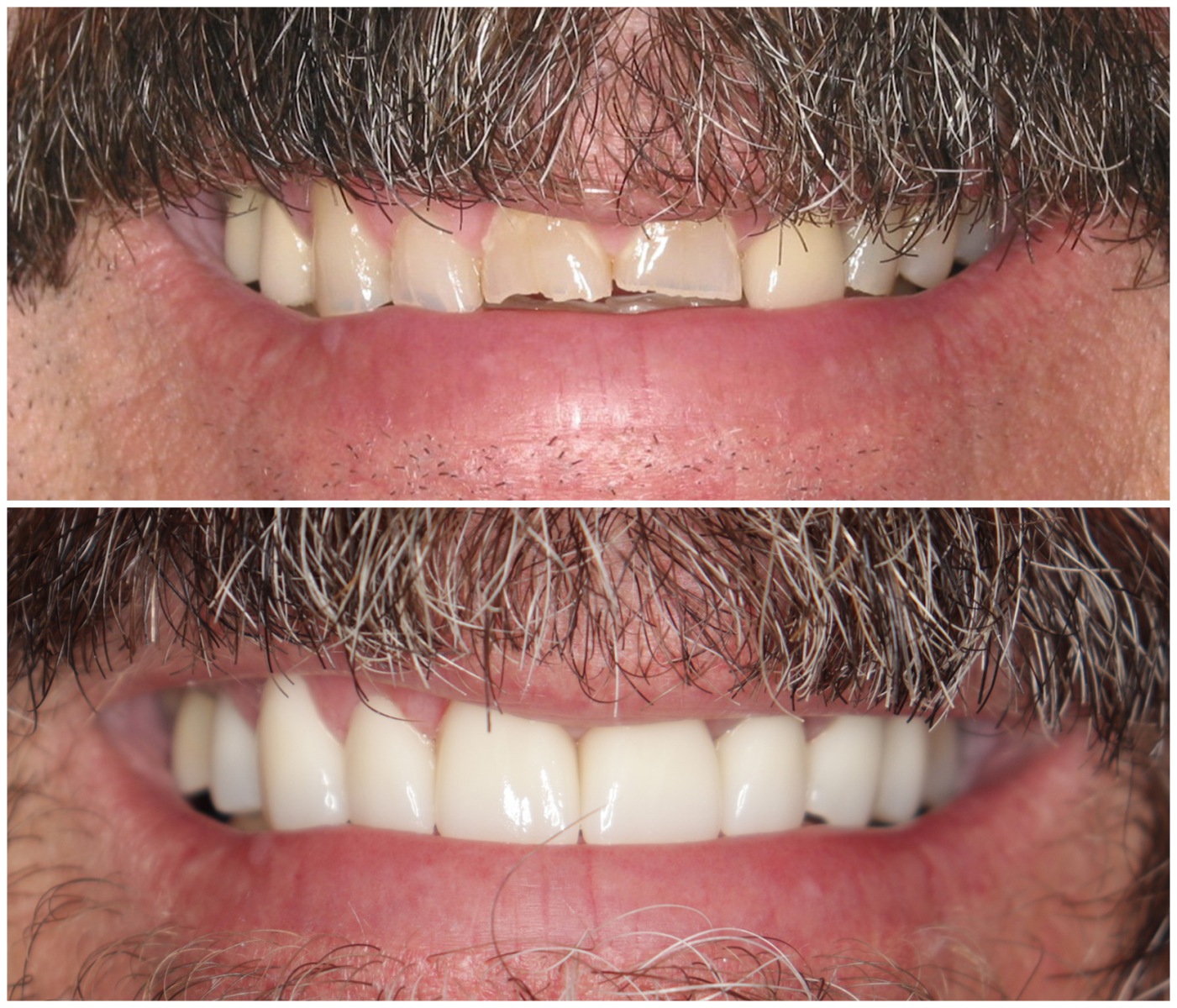 Before and After Image: Porcelain Crowns - front