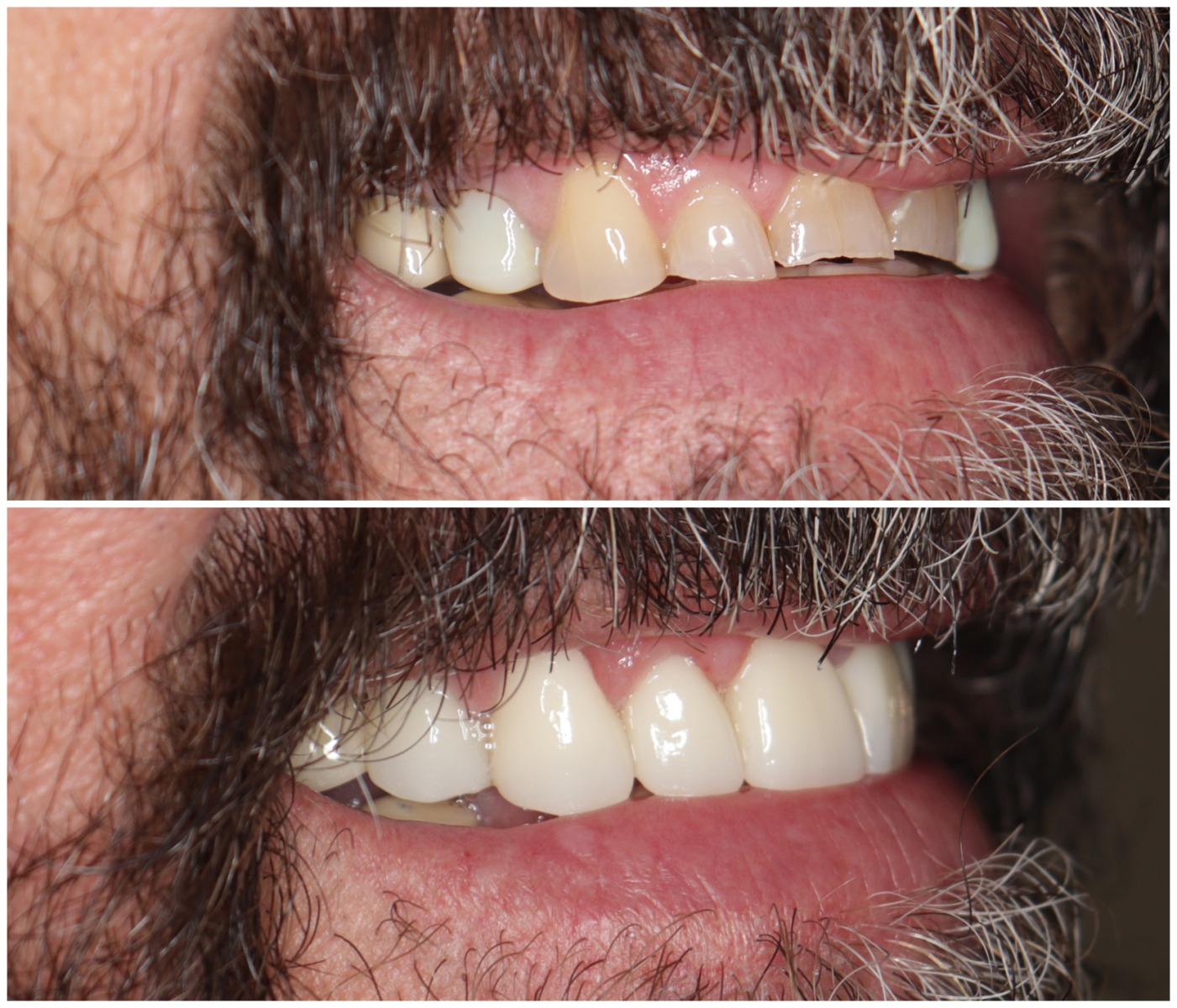 Before and After Image: Porcelain Crowns - right-front-oblique
