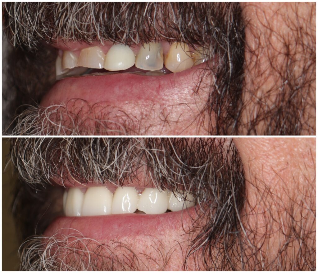 Before and After Image: Porcelain Crowns - left-front-oblique