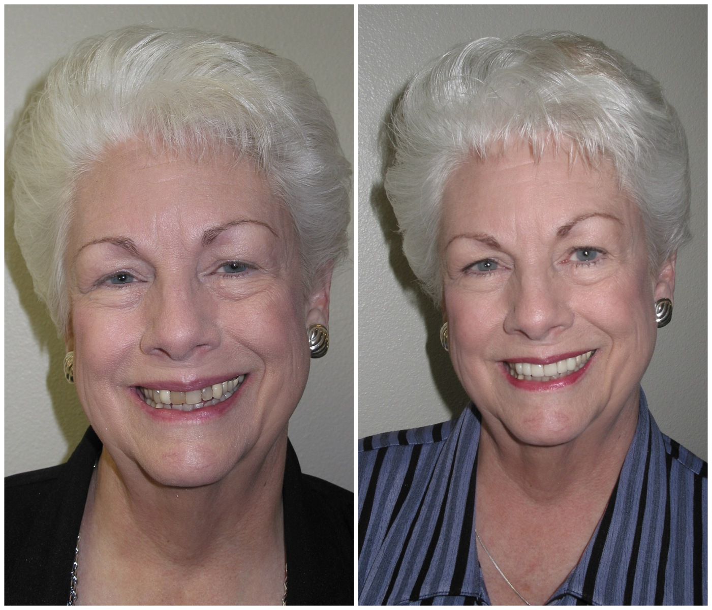Before and After Image: Porcelain Crowns - front