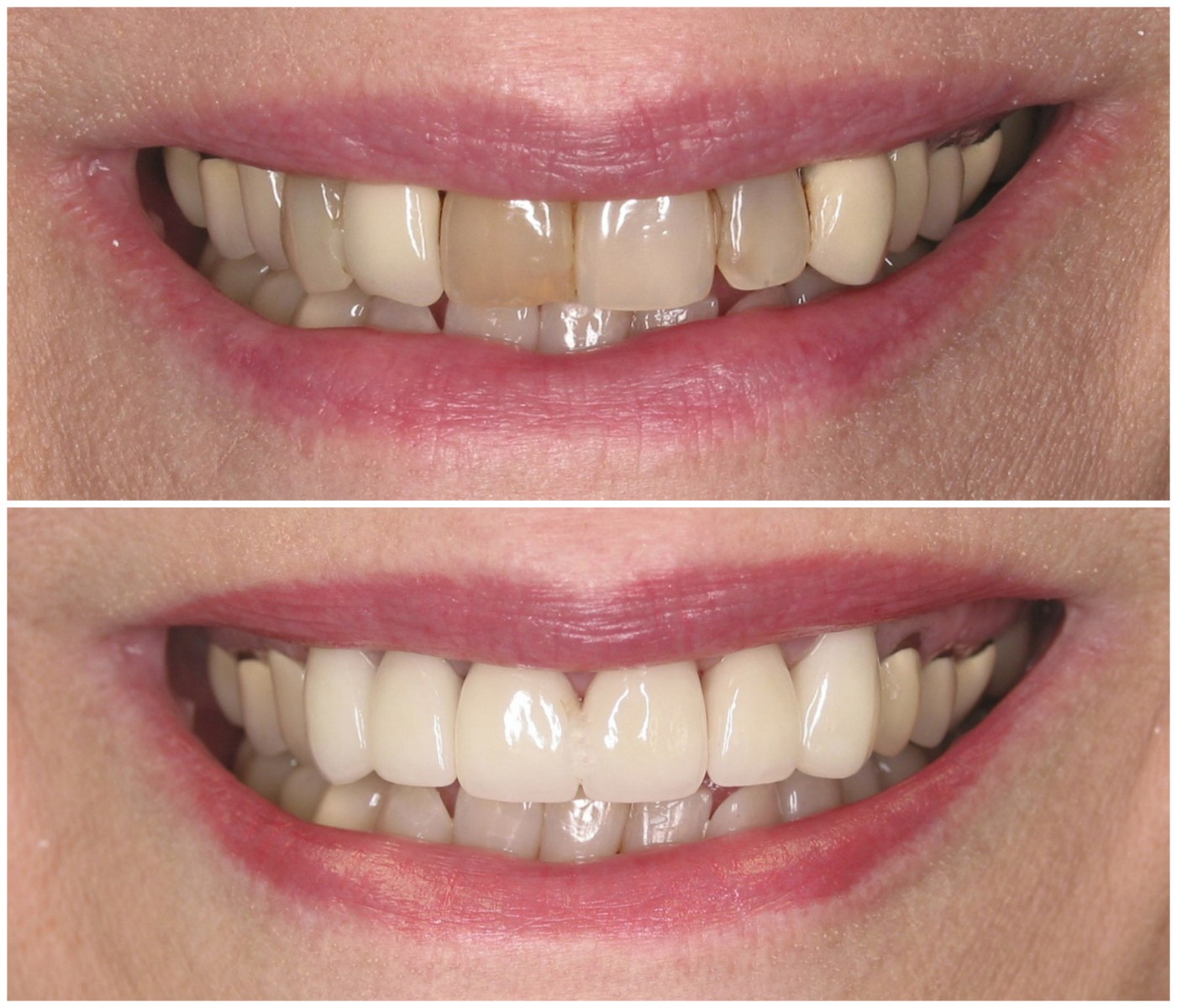 Before and After Image: Porcelain Crowns - front