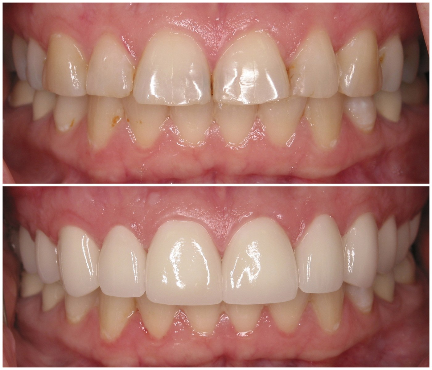Before and After Image: Porcelain Crowns - front